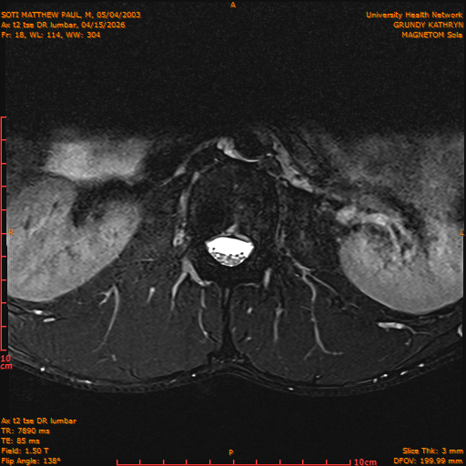 2026-04-15/Entire Spine/Ax t2 tse DR lumbar/0019-IM129.png