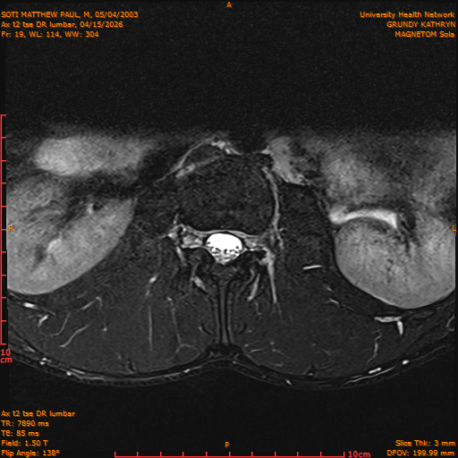 2026-04-15/Entire Spine/Ax t2 tse DR lumbar/0020-IM130.png