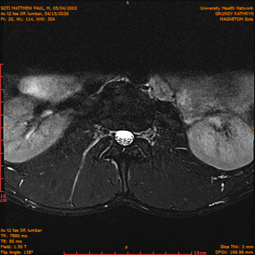 2026-04-15/Entire Spine/Ax t2 tse DR lumbar/0021-IM131.png