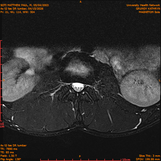 2026-04-15/Entire Spine/Ax t2 tse DR lumbar/0022-IM132.png