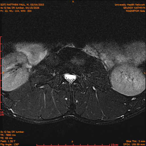 2026-04-15/Entire Spine/Ax t2 tse DR lumbar/0023-IM133.png