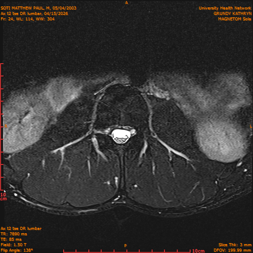 2026-04-15/Entire Spine/Ax t2 tse DR lumbar/0025-IM135.png