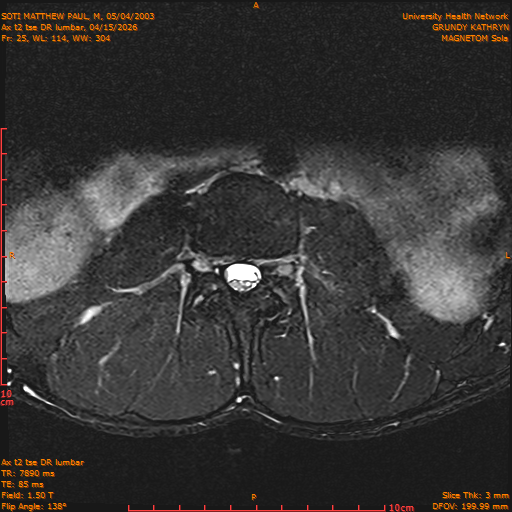 2026-04-15/Entire Spine/Ax t2 tse DR lumbar/0026-IM136.png