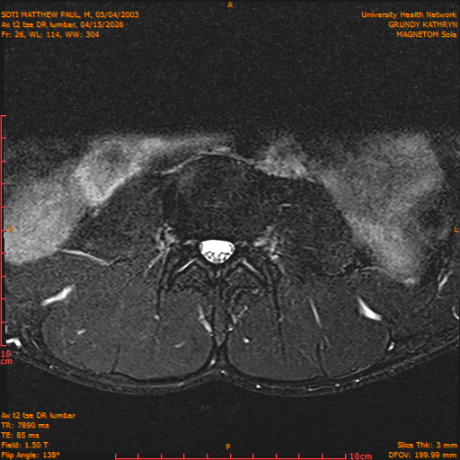 2026-04-15/Entire Spine/Ax t2 tse DR lumbar/0027-IM137.png