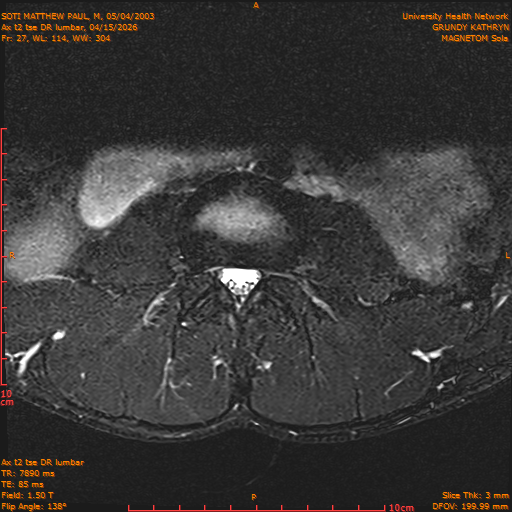 2026-04-15/Entire Spine/Ax t2 tse DR lumbar/0028-IM138.png