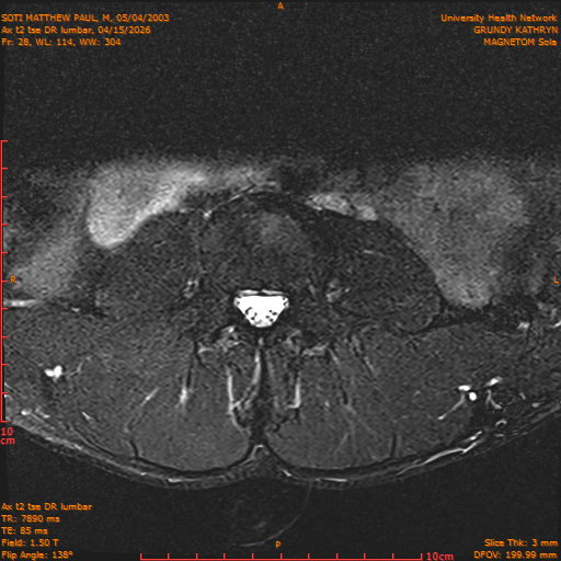 2026-04-15/Entire Spine/Ax t2 tse DR lumbar/0029-IM139.png