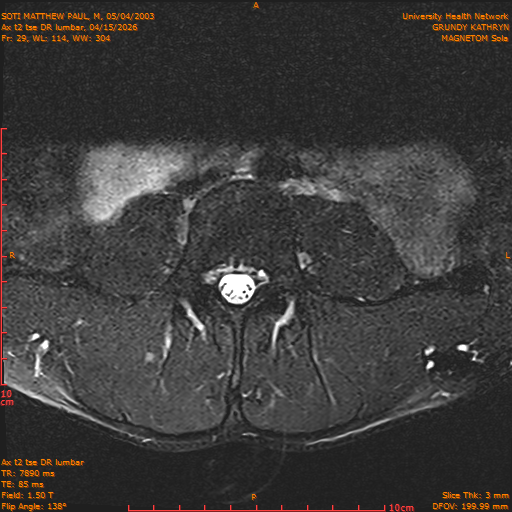 2026-04-15/Entire Spine/Ax t2 tse DR lumbar/0030-IM140.png