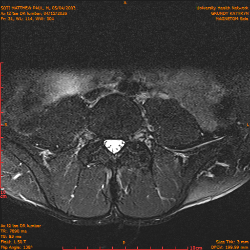 2026-04-15/Entire Spine/Ax t2 tse DR lumbar/0032-IM142.png