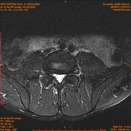 2026-04-15/Entire Spine/Ax t2 tse DR lumbar/0033-IM143.png