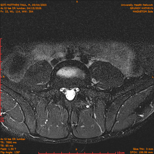 2026-04-15/Entire Spine/Ax t2 tse DR lumbar/0034-IM144.png