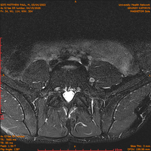 2026-04-15/Entire Spine/Ax t2 tse DR lumbar/0035-IM145.png