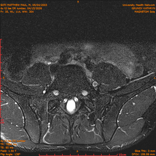 2026-04-15/Entire Spine/Ax t2 tse DR lumbar/0036-IM146.png