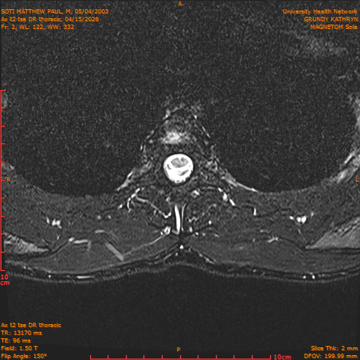 2026-04-15/Entire Spine/Ax t2 tse DR thoracic/0003-.png