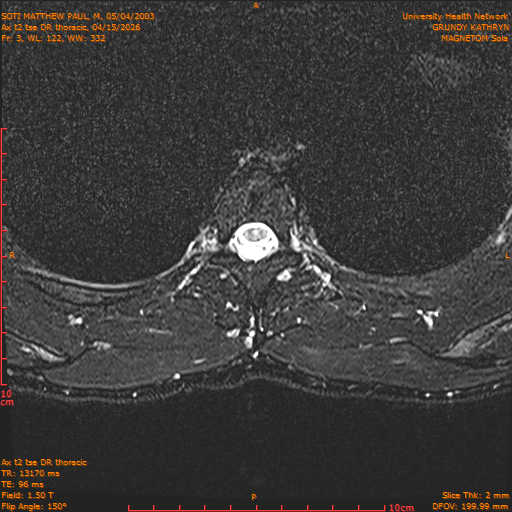 2026-04-15/Entire Spine/Ax t2 tse DR thoracic/0004-.png