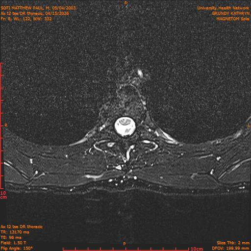 2026-04-15/Entire Spine/Ax t2 tse DR thoracic/0009-.png