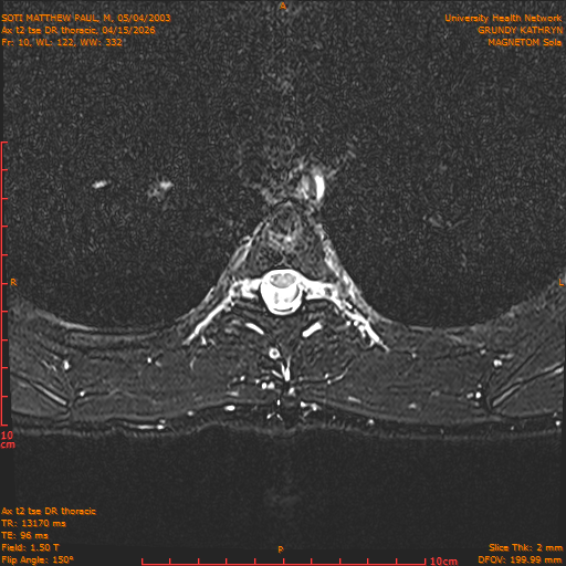2026-04-15/Entire Spine/Ax t2 tse DR thoracic/0011-.png
