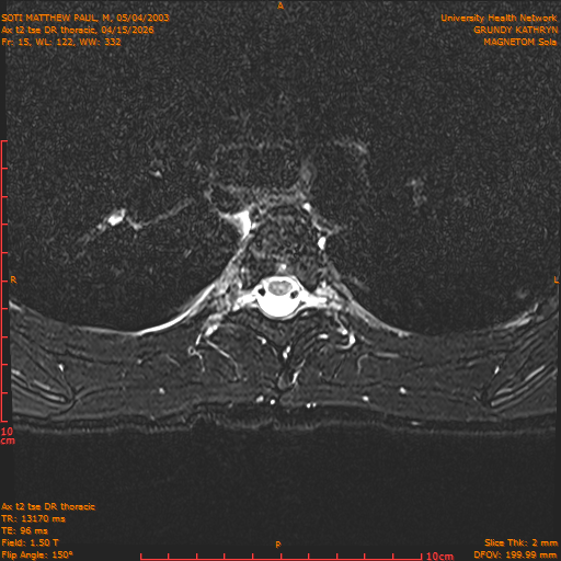 2026-04-15/Entire Spine/Ax t2 tse DR thoracic/0016-.png