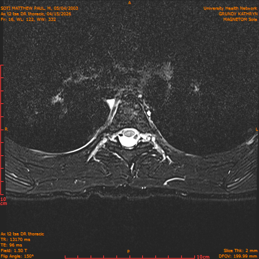 2026-04-15/Entire Spine/Ax t2 tse DR thoracic/0017-.png