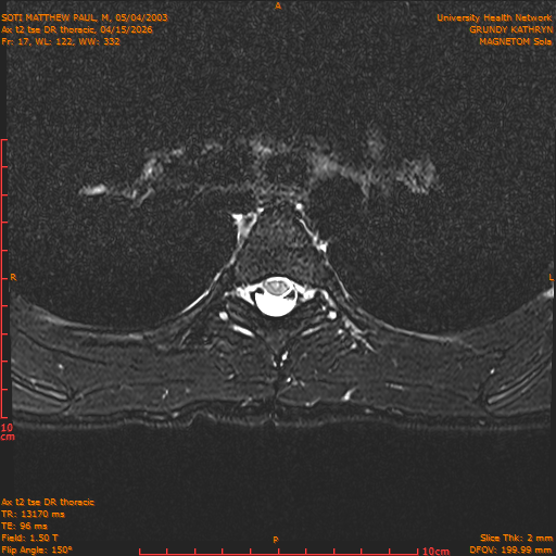 2026-04-15/Entire Spine/Ax t2 tse DR thoracic/0018-.png