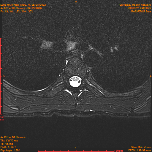 2026-04-15/Entire Spine/Ax t2 tse DR thoracic/0020-.png