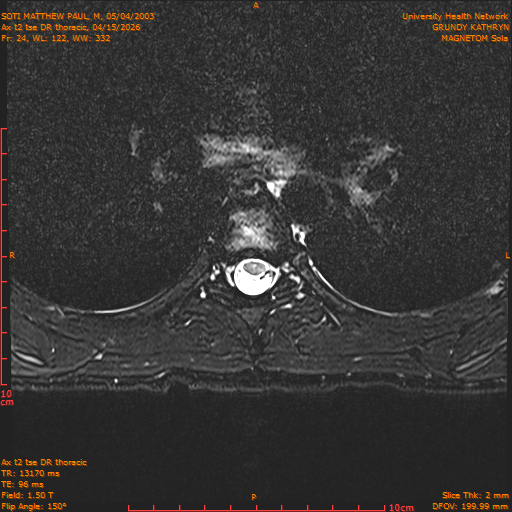 2026-04-15/Entire Spine/Ax t2 tse DR thoracic/0025-.png