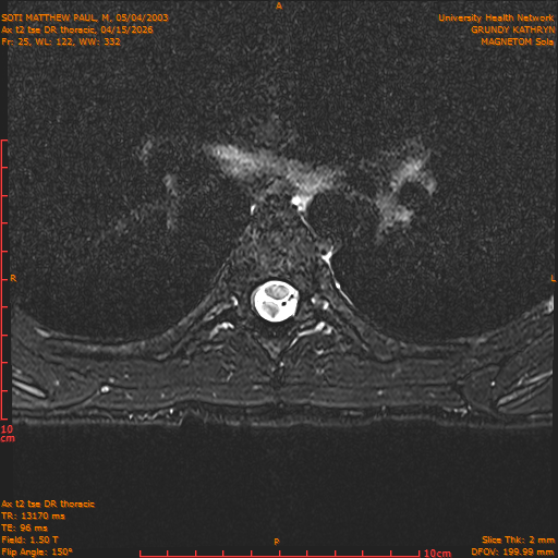 2026-04-15/Entire Spine/Ax t2 tse DR thoracic/0026-.png