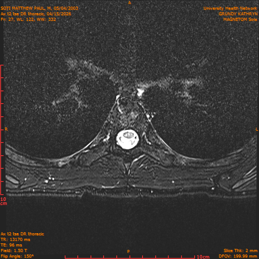 2026-04-15/Entire Spine/Ax t2 tse DR thoracic/0028-.png