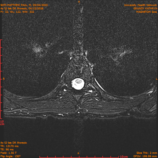 2026-04-15/Entire Spine/Ax t2 tse DR thoracic/0033-.png