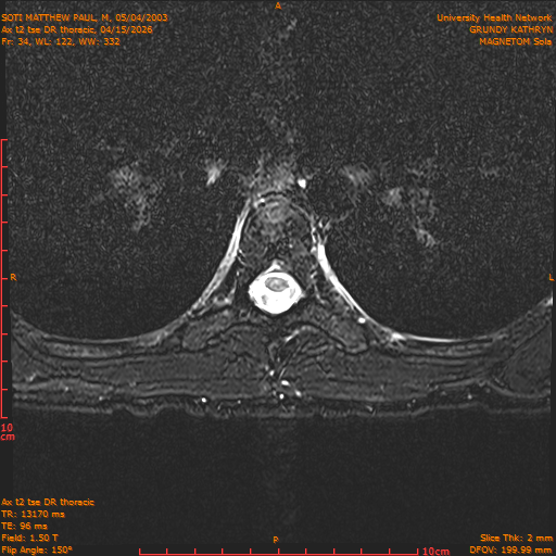 2026-04-15/Entire Spine/Ax t2 tse DR thoracic/0035-.png