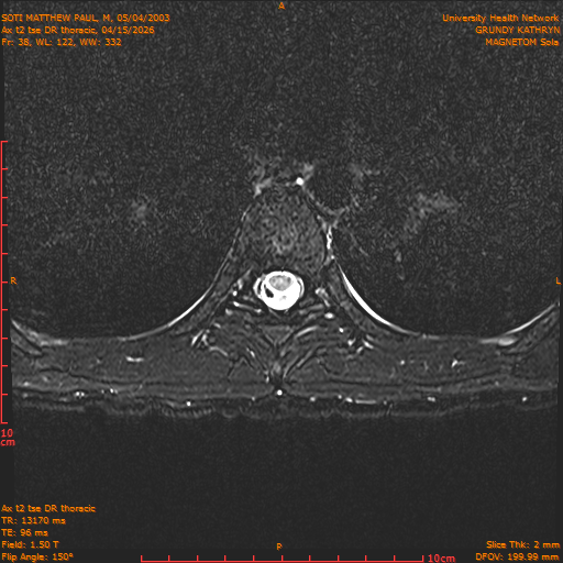 2026-04-15/Entire Spine/Ax t2 tse DR thoracic/0039-.png