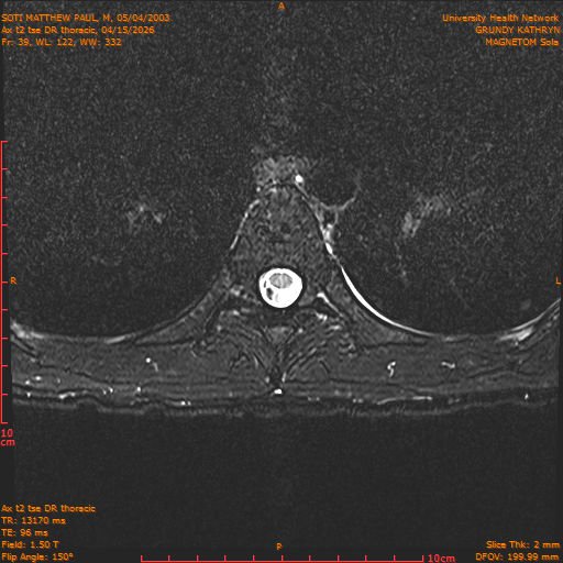 2026-04-15/Entire Spine/Ax t2 tse DR thoracic/0040-.png