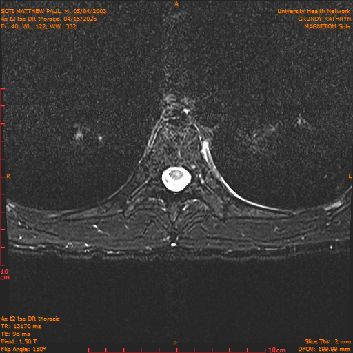 2026-04-15/Entire Spine/Ax t2 tse DR thoracic/0041-.png
