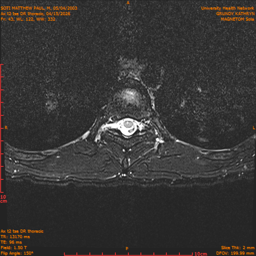 2026-04-15/Entire Spine/Ax t2 tse DR thoracic/0044-IM100.png