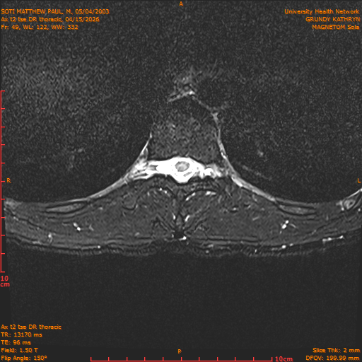 2026-04-15/Entire Spine/Ax t2 tse DR thoracic/0050-IM106.png