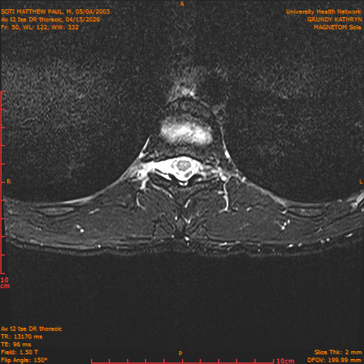 2026-04-15/Entire Spine/Ax t2 tse DR thoracic/0051-IM107.png