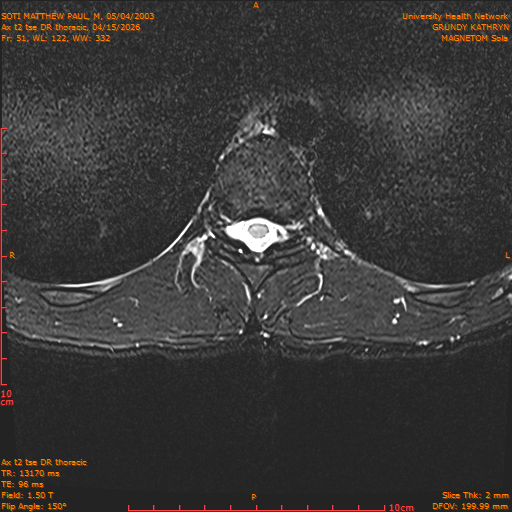2026-04-15/Entire Spine/Ax t2 tse DR thoracic/0052-IM108.png