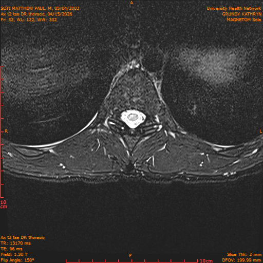 2026-04-15/Entire Spine/Ax t2 tse DR thoracic/0053-IM109.png