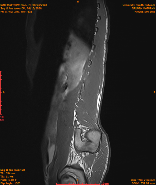 2026-04-15/Entire Spine/Sag t1 tse lower DR/0001-IM212.png