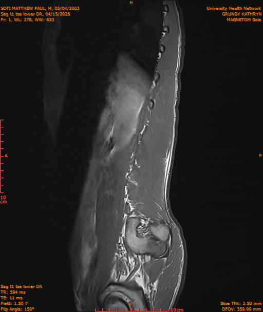 2026-04-15/Entire Spine/Sag t1 tse lower DR/0002-IM213.png