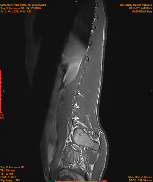 2026-04-15/Entire Spine/Sag t1 tse lower DR/0004-IM215.png