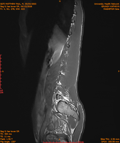 2026-04-15/Entire Spine/Sag t1 tse lower DR/0005-IM216.png