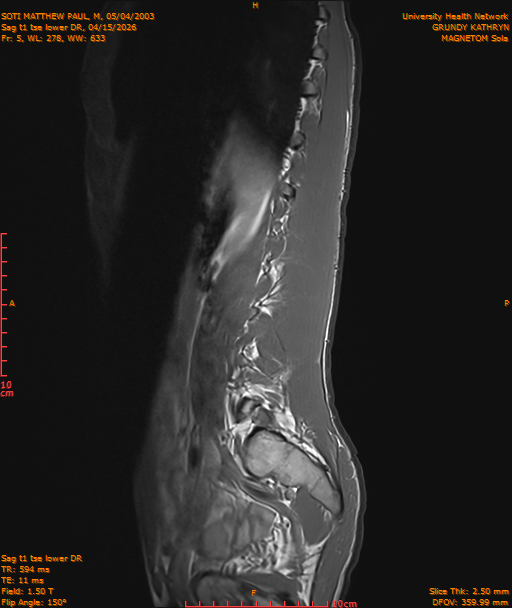 2026-04-15/Entire Spine/Sag t1 tse lower DR/0006-IM217.png