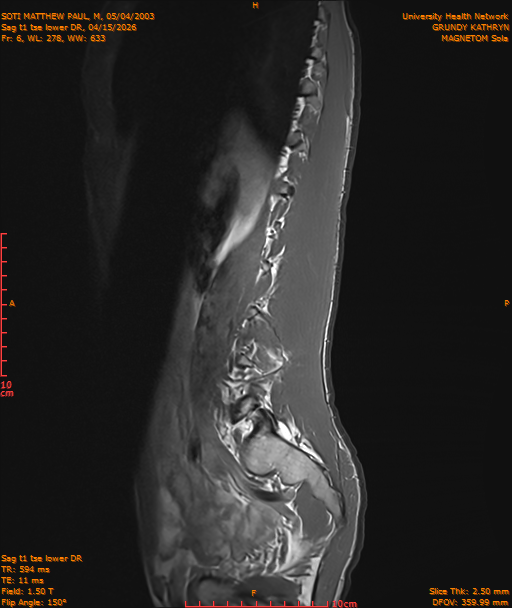 2026-04-15/Entire Spine/Sag t1 tse lower DR/0007-IM218.png