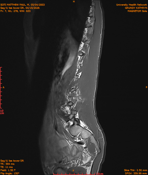 2026-04-15/Entire Spine/Sag t1 tse lower DR/0008-IM219.png