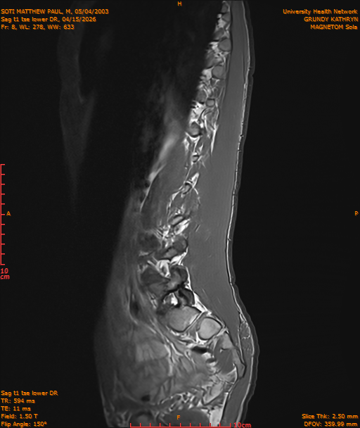 2026-04-15/Entire Spine/Sag t1 tse lower DR/0009-IM220.png