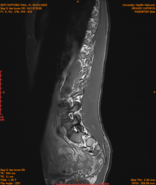 2026-04-15/Entire Spine/Sag t1 tse lower DR/0010-IM221.png