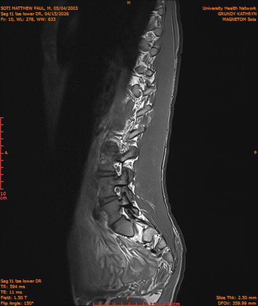 2026-04-15/Entire Spine/Sag t1 tse lower DR/0011-IM222.png