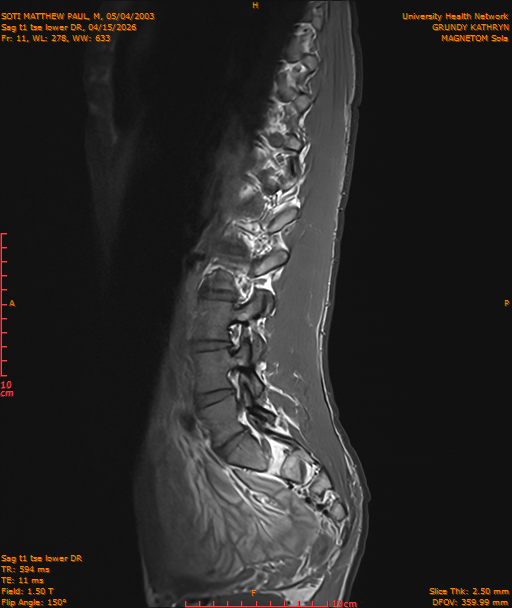 2026-04-15/Entire Spine/Sag t1 tse lower DR/0012-IM223.png