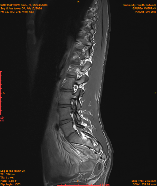 2026-04-15/Entire Spine/Sag t1 tse lower DR/0013-IM224.png