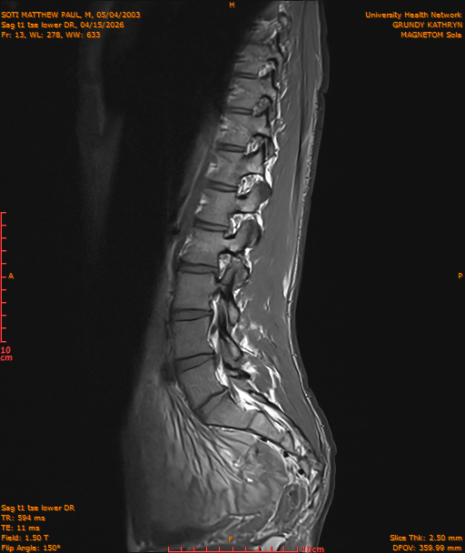 2026-04-15/Entire Spine/Sag t1 tse lower DR/0014-IM225.png